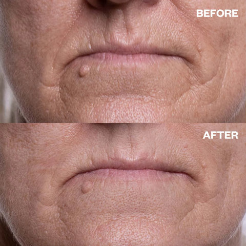 Wrinkle Schminkles Mouth & Lip Wrinkle Patches - Set Of 2 Patches